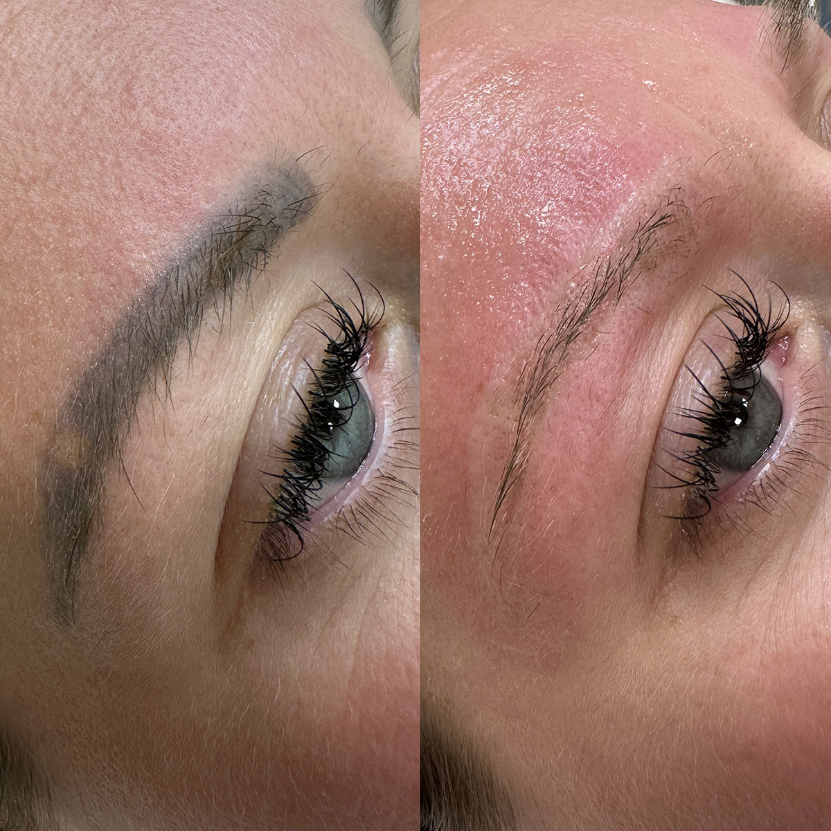 Laser Tattoo & Permanent Makeup Removal